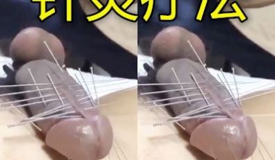 这是什么他妈的疗法针灸鸡巴