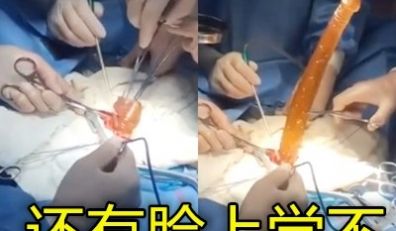 屄里塞了一个近一米的假鸡巴在医院被取出丢死人了