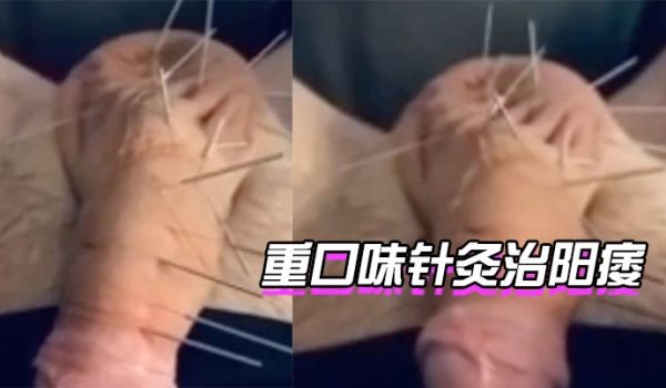 针灸治阳痿你想试下吗