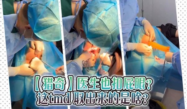 【猎奇】医生也扣屁眼？ 这tmd 取出来的是啥？